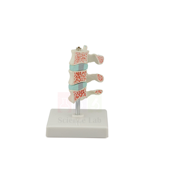 Human Advanced Osteoporosis Model